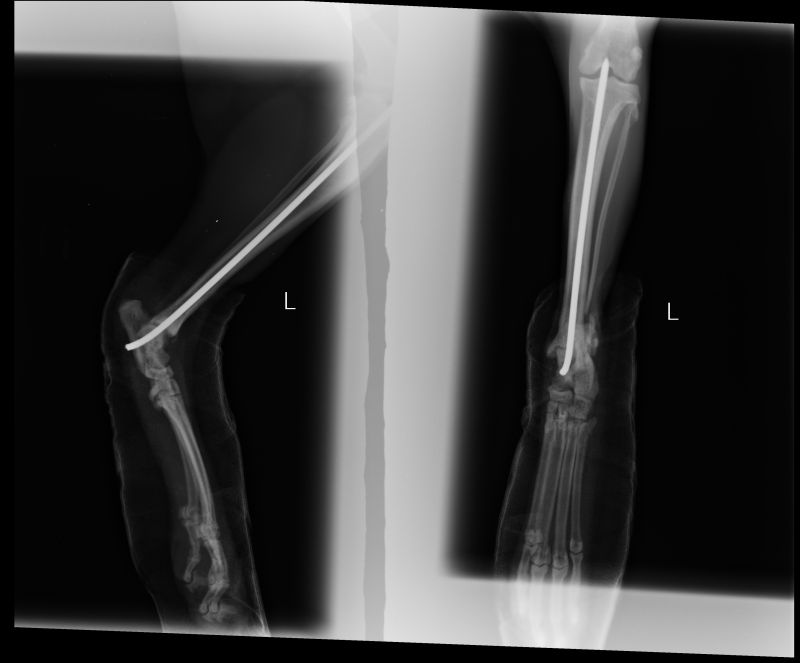 fracture-healed