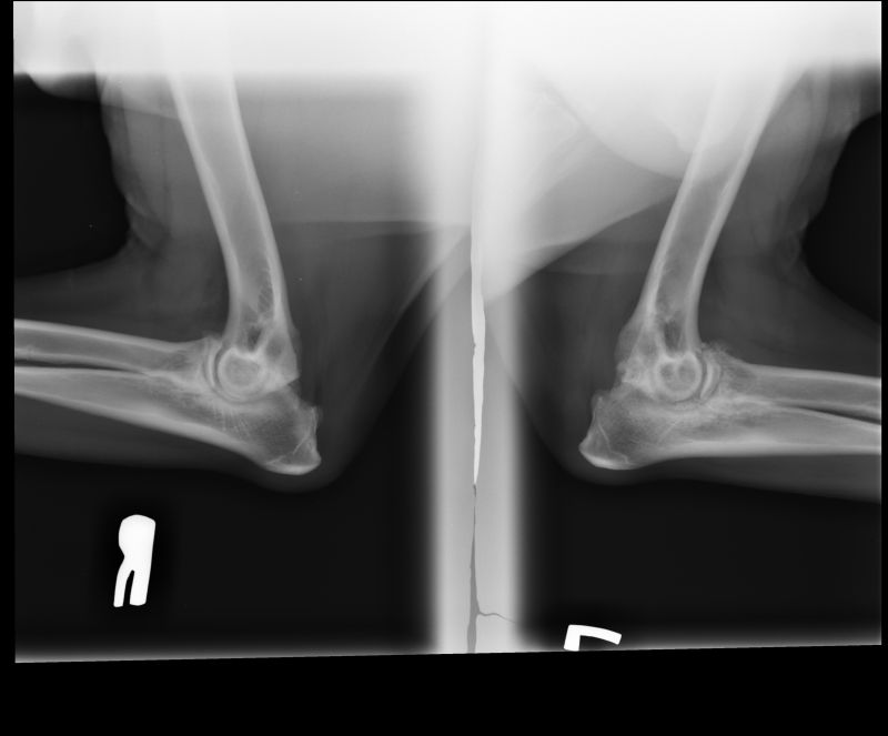 mild-elbow-dysplasia